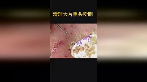 清理黑头粉刺视频,跟我学视频清洁术